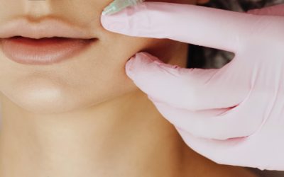 What Can I Do to Prepare for My Lip Filler Treatment?