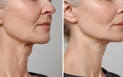 What Is the Nefertiti Neck Lift and Is It Right for You?