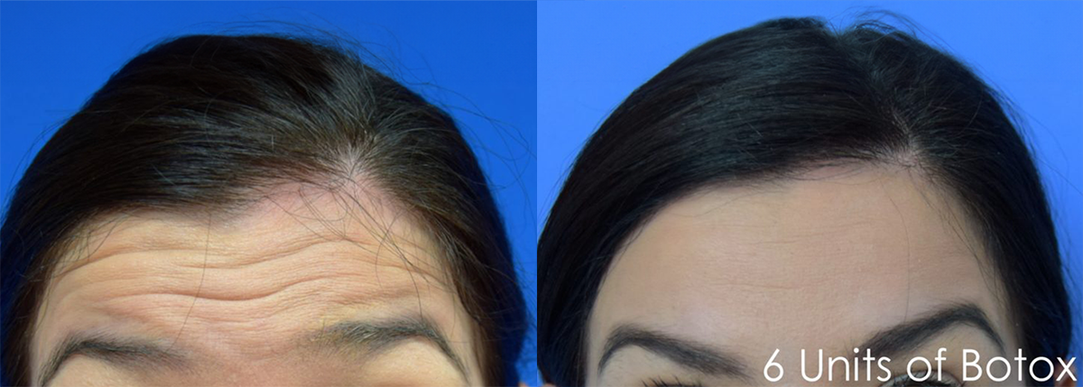 Botox Brow Lift: Before And After - Aesthetic Lane