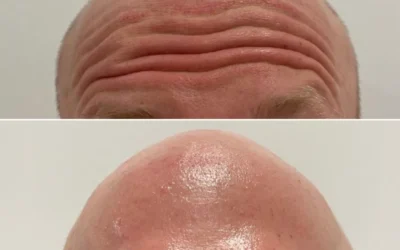 Botox for Forehead Wrinkles: How Many Units & Results Timeline