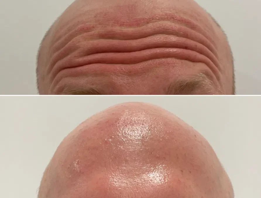 Wrinkle-Reduction-Treatment-before-after-1