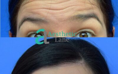 Botox Brow Lift: Before & After Photos, Cost & Benefits