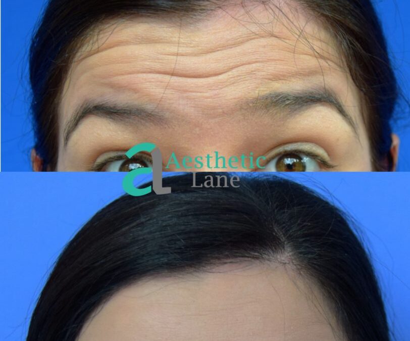 botox brow drooping orlando and winterpark
