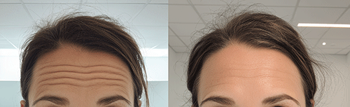 Botox for Forehead Wrinkles
